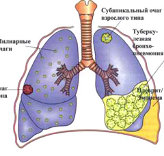 Контрольная работа по теме Вирус иммунодефицита человека и туберкулез