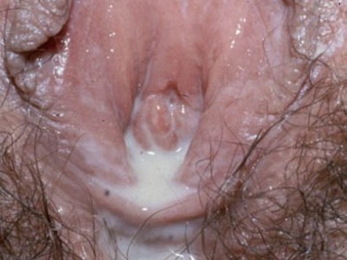 вагинит при нарушении микрофлоры влагалища