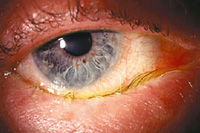 Болят веки глаз — почему болят веки? Что делать если болят веки глаз?