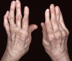 Ревматоидный артрит: лечится ли артрит навсегда