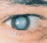 Иридоциклит глаза:симпотомы - "Здоровое око"