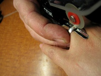 Как снять кольцо если опух палец