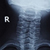 Рентген шейного отдела позвоночника. Рентгенологическая картина в норме и при различных заболеваниях