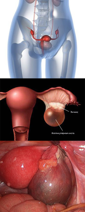 Дифференциальная диагностика кисты правого яичника thumbnail