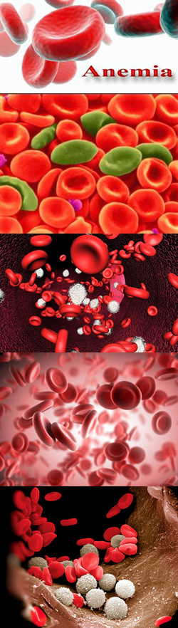 Гипохромная анемия: причины, симптомы, диагностика и лечение
