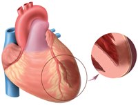Отклонения в кардиограмме сердца