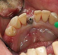 Протезирование зубов и имплантация