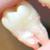 Зубы мудрости: лечение, удаление, уход за лункой после удаления
