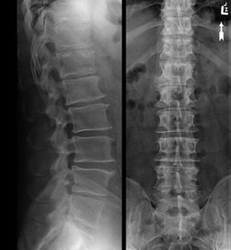 Показывает ли рентген остеохондроз - первые признаки, профилактика, расшифровка, ﻿что это