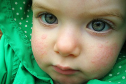 Аллергическая крапивница: более 7 симптомов фото, лечение 35 препаратов у детей и взрослых, причины, диагностика