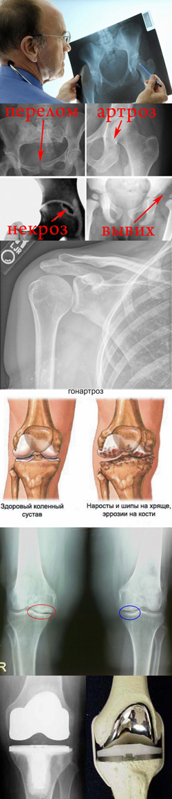 Рентгеноанатомия голеностопного сустава