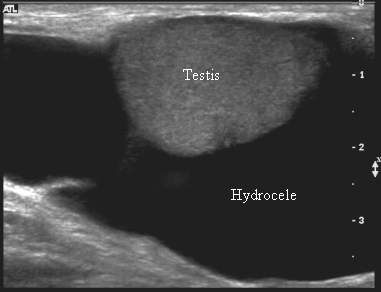 Водянка яичка у мужчин после операции паховой грыжи фото