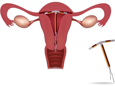 Подробно о контрацепции: внутриматочная спираль
