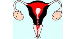 полипы шейки матки и менструальный цикл