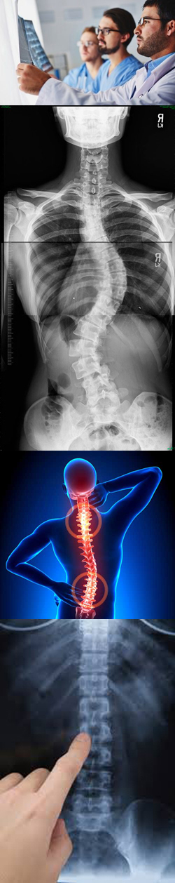 Рентген грудного и поясничного отдела позвоночника