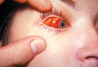 Лечение глаз инъекциями эмоксипин