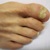 Онихомикоз (грибок ногтей) – причины, виды, симптомы, диагностика, лечение и профилактика