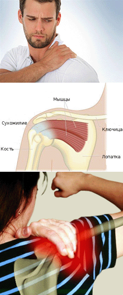 Боль в плечевых мышцах