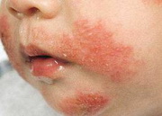Диагностические критерии атопического дерматита у детей thumbnail