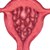 Что такое гиперплазия эндометрия?