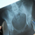 Рентген суставов. Рентгенологическая картина в норме и при различных заболеваниях суставов