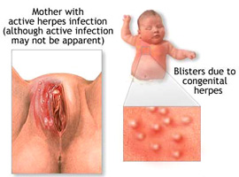 Какие болезни нельзя выявить во время беременности. Как не заболеть краснухой. Заболевание герпесом половых органов
