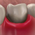 Абсцесс зуба – Что это такое?