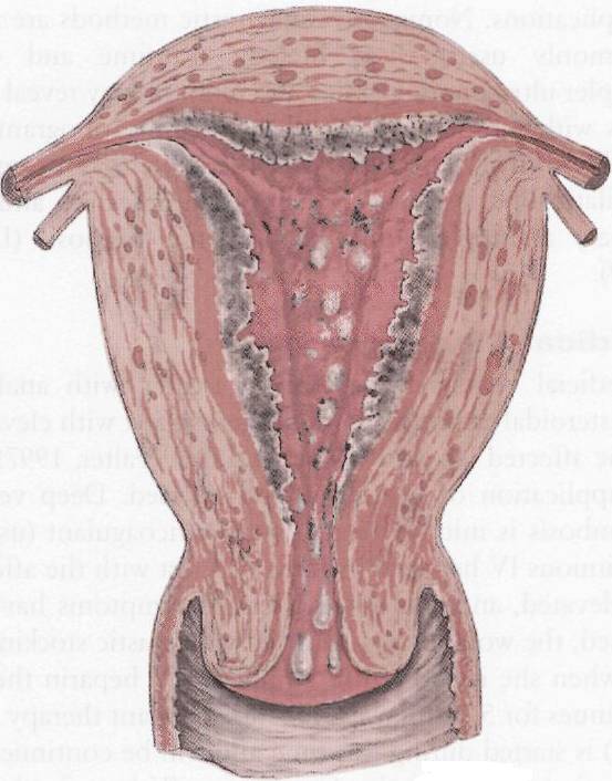 Воспаление внутренней оболочки матки. Септический эндометрит макропрепарат. Послеродовый метроэндометрит.