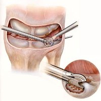 Лапароскопия коленного сустава восстановление после операции