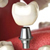 Удаление зуба с одномоментным восстановлением. Техника процедуры. Показания, противопоказания и возможные осложнения