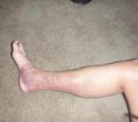 Болят ноги ниже колен с внешней стороны. Ноет нога: причины и лечение. Боль под коленом спереди