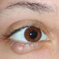 Ячмень на глазу лечение тобрадекс