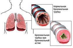Признак не характерный для бронхиальной астмы