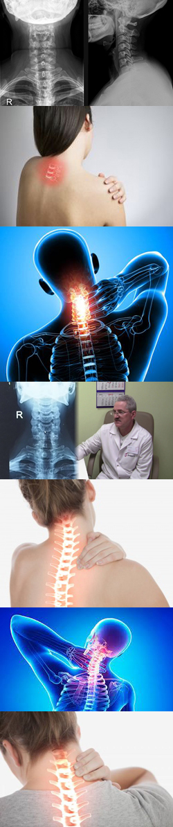 Рентген шейного отдела позвоночника: что показывает и как делается