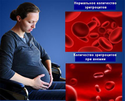 Анемия при беременности: симптомы и последствия, как проявляется легкой степени или 2, 3 у беременных, почему появляется недостаток железа, и как его лечить медикаментозно