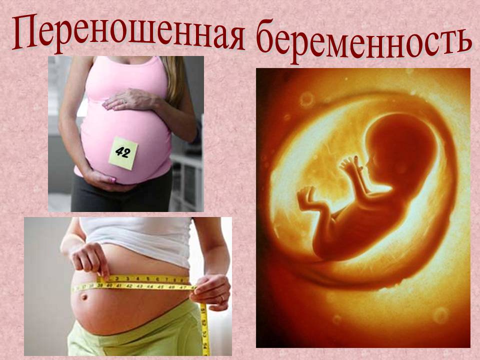 Плод 41 неделя. Переношенная беременность. Симптомы переношенной беременности. Переношенная и пролонгированная беременность. Истинно переношенная беременность.