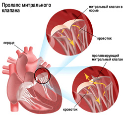 Колит сердце пролапс митрального клапана