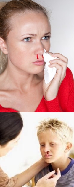Носовое кровотечение (кровотечение из носа)