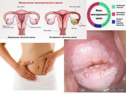  лейкоплакия шейки матки и менструальный цикл
