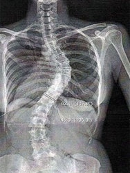 Показывает ли рентген остеохондроз - первые признаки, профилактика, расшифровка, ﻿что это