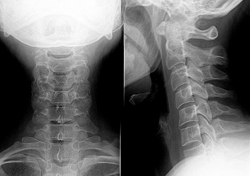 Рентген шейного отдела позвоночника: что показывает и как делается