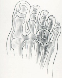Боль в подушечках пальцев ног при ходьбе
