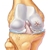 Гонартроз (остеоартроз коленного сустава) - симптомы, степени, лечение, народные средства, диета