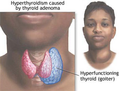Диффузный зоб щитовидной железы у детей thumbnail