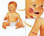 Диагностические критерии атопического дерматита у детей