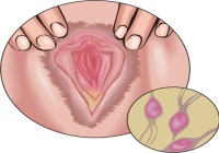 Лечение от вагинальных грибков