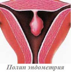 причины возникновения плацентарных полипов матки