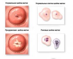полипы матки и рак