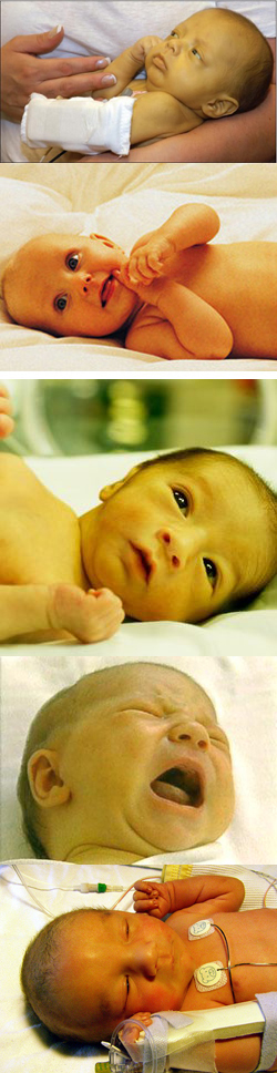 Ребенок желтуха почему. Желтушка у новорожденных. Внутриутробная желтушка. Родовая желтушка у новорожденных. Неонатальная желтуха физиологическая.