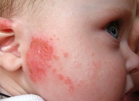 Унидерм при атопическом дерматите у ребенка